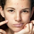 Acne Facials: A Comprehensive Guide